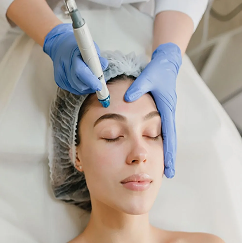 Scalp microneedling treatment for hair density restoration