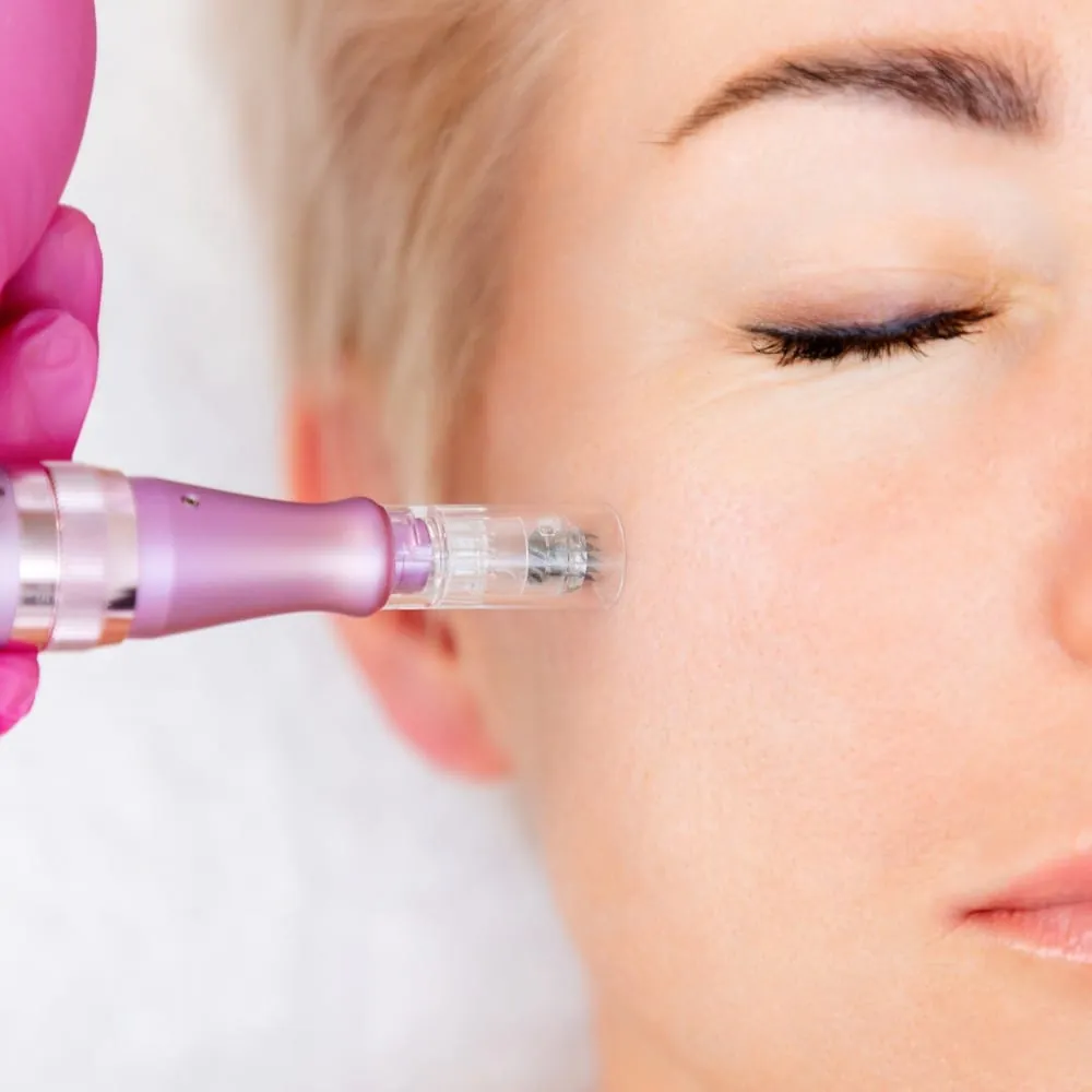 TWIST microneedling for Waterloo students at Silkentouch